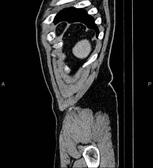 Acute appendicitis (Radiopaedia 84780-100240 Sagittal C+ portal venous phase 102).jpg