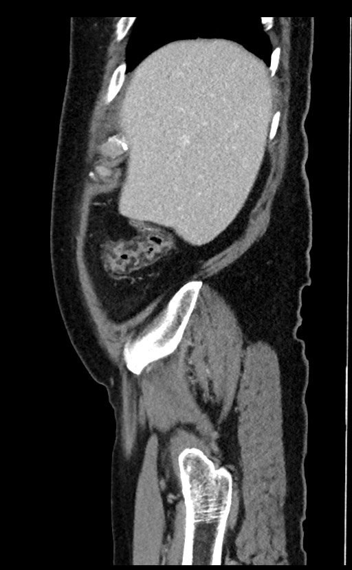 Acute appendicitis - large appendicoliths (Radiopaedia 61805-69820 Sagittal C+ portal venous phase 99).jpg