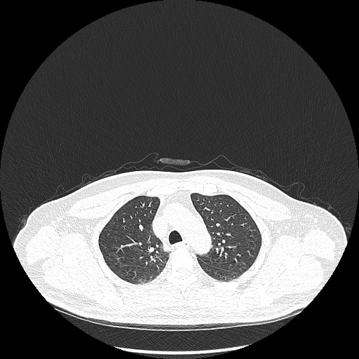 Acute appendicitis and COVID 19 pneumonia (Radiopaedia 76604-88380 Axial lung window 16).jpg