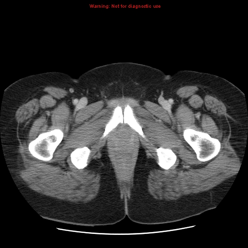 Acute appendicitis complicated by ovarian vein thrombophlebitis (Radiopaedia 16172-15851 Axial C+ portal venous phase 90).jpg