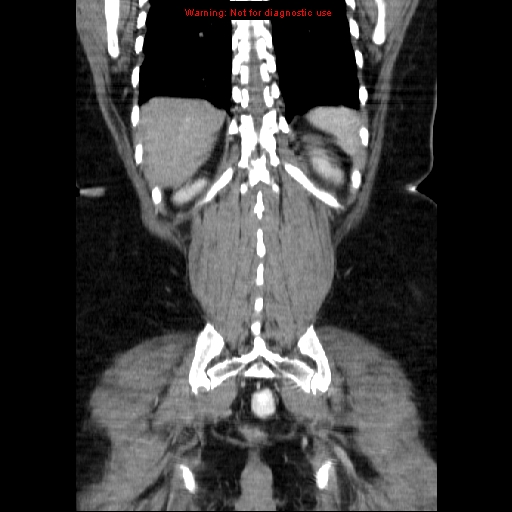 Acute appendicitis complicated by ovarian vein thrombophlebitis (Radiopaedia 16172-15851 Coronal C+ portal venous phase 66).jpg