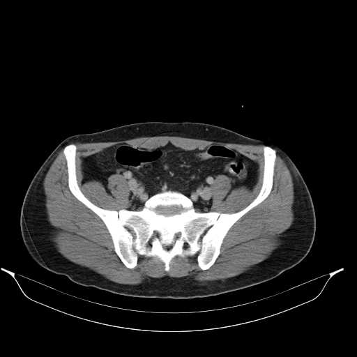 File:Acute appendicitis with appendicoliths (Radiopaedia 21148-21062 Axial C+ portal venous phase 16).jpg