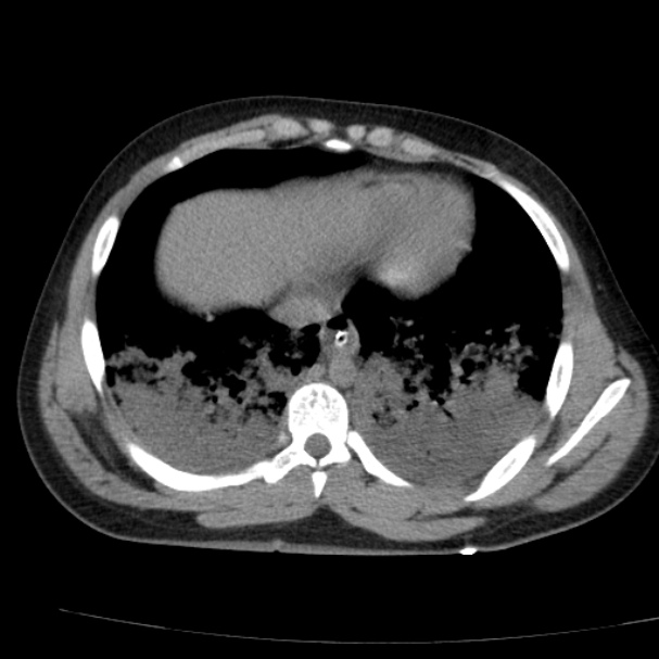 Acute aspiration pneumonitis (Radiopaedia 33605-34703 Axial non-contrast 62).jpg