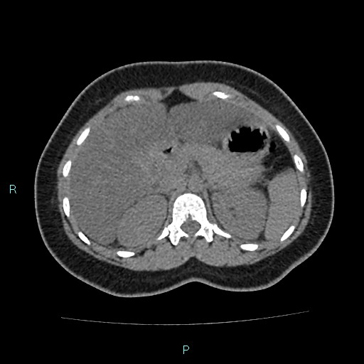 Acute bilateral pyelonephritis (Radiopaedia 37146-38881 Axial non-contrast 32).jpg