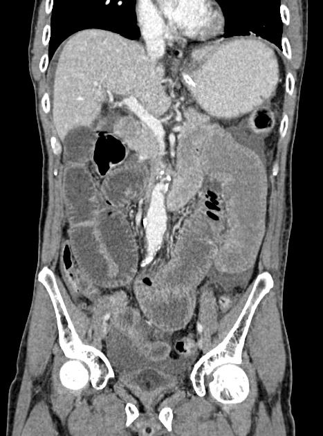 Acute bowel ischemia (Radiopaedia 87695-104114 Coronal C+ portal venous phase 188).jpg