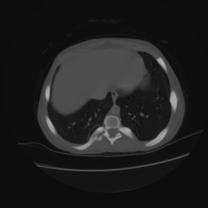 File:Acute calculous cholecystitis in patient with osteopetrosis (Radiopaedia 77871-90159 Axial bone window 4).jpg