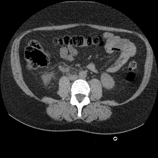Acute cholecystitis and ureteric colic (Radiopaedia 42330-45444 Axial prone 56).jpg