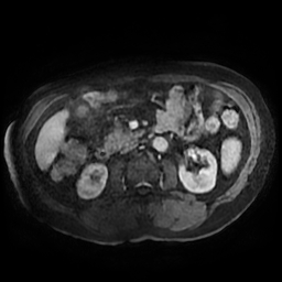 Acute cholecystitis complicated by pylephlebitis (Radiopaedia 65782-74915 Axial arterioportal phase T1 C+ fat sat 88).jpg