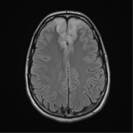 File:Acute disseminated encephalomyelitis (ADEM) (Radiopaedia 65319-74349 Axial FLAIR 22).png