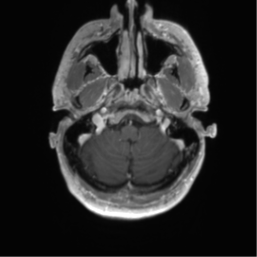 Acute disseminated encephalomyelitis (ADEM) (Radiopaedia 65319-74350 Axial T1 C+ 3).png