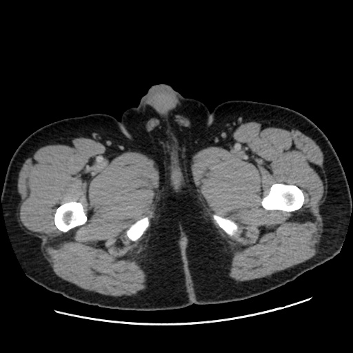 File:Acute diverticulitis with localized perforation (Radiopaedia 41296-44113 Axial C+ portal venous phase 102).jpg