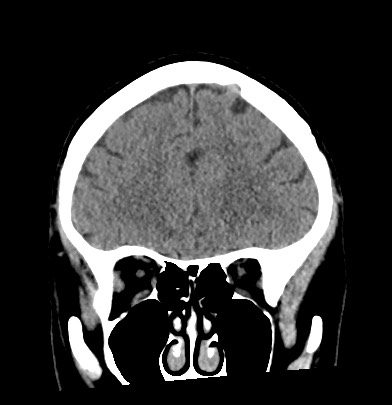 File:Acute internal carotid artery dissection (Radiopaedia 53541-59558 Coronal non-contrast 22).jpg