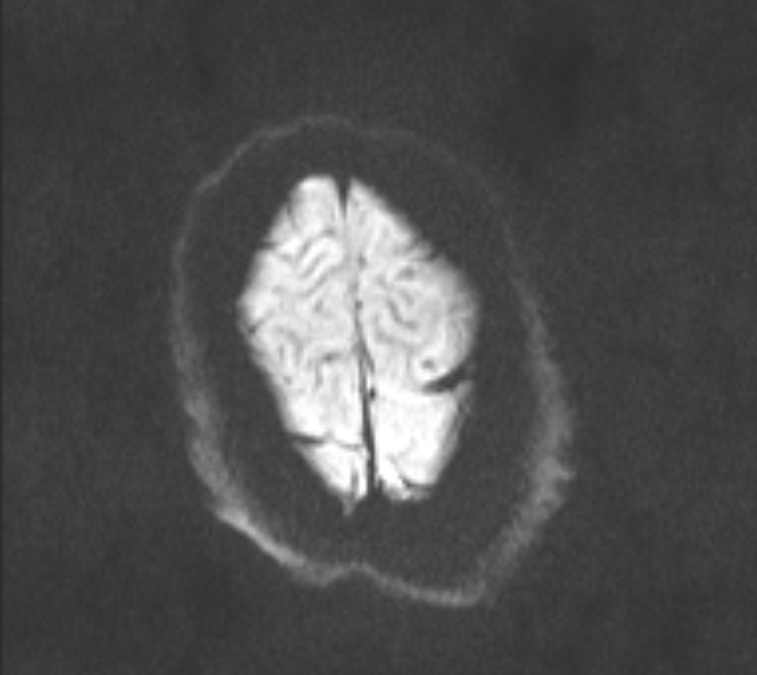 Acute ischemic stroke - posterior circulation territory (Radiopaedia 77670-89880 Axial DWI 45).jpg