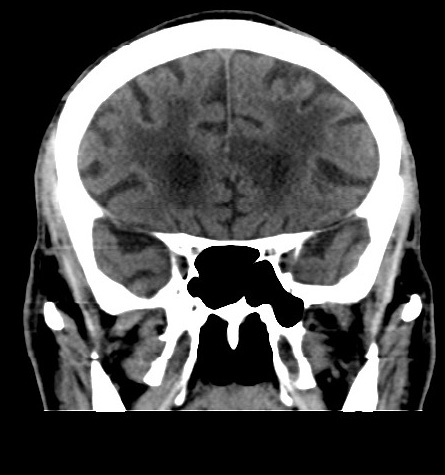File:Acute left anterior cerebral artery territory infarction (Radiopaedia 51785-57578 Coronal non-contrast 20).jpg