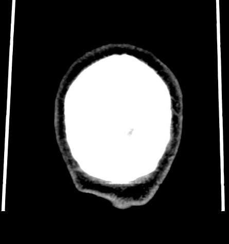 Acute left anterior cerebral artery territory infarction (Radiopaedia 51785-57578 Coronal non-contrast 58).jpg