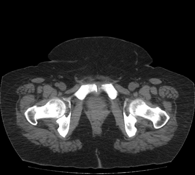 Acute mesenteric ischemia (Radiopaedia 80029-93316 Axial non-contrast 87).jpg