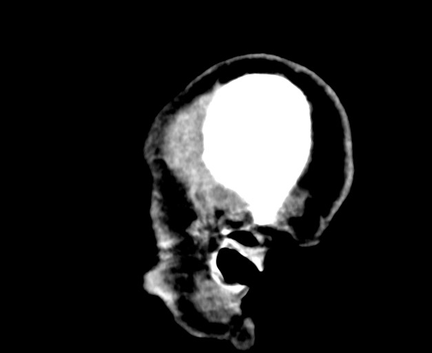 Acute on chronic subdural hematoma (Radiopaedia 78346-90966 Sagittal non-contrast 8).jpg