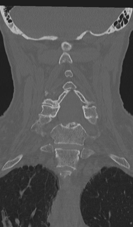 Acute on chronic subdural hematoma and thoracic vertebral injury in a multitrauma patient (Radiopaedia 31698-32619 Coronal bone window 35).jpg