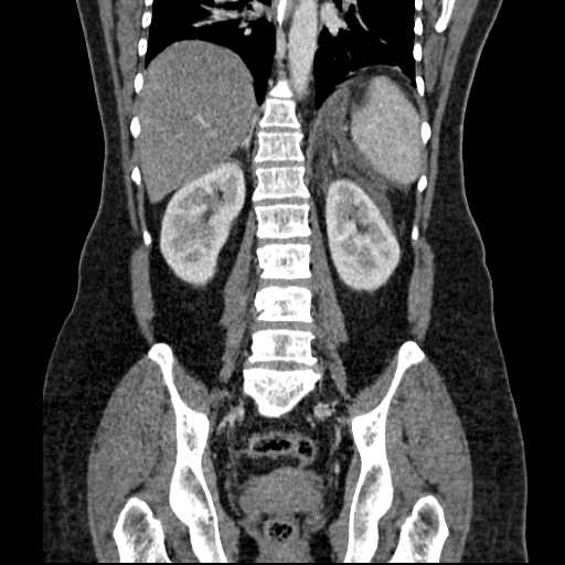 File:Acute pancreatitis (Radiopaedia 20829-20744 Coronal C+ portal venous phase 38).jpg