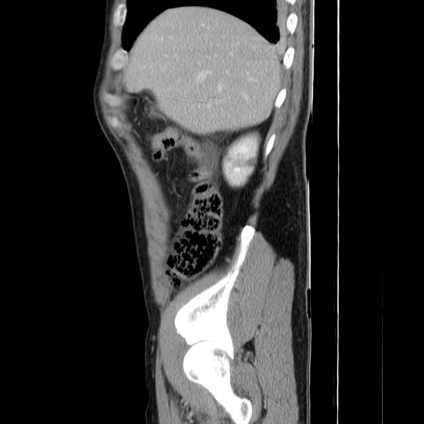 Acute pancreatitis (Radiopaedia 22572-22596 Sagittal C+ portal venous phase 11).jpg