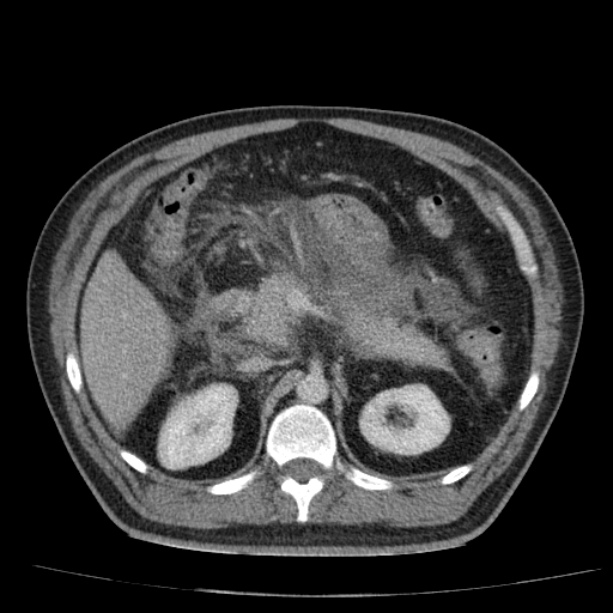 Acute pancreatitis (Radiopaedia 26663-26813 Axial C+ portal venous phase 29).jpg