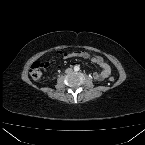 Acute pancreatitis - Balthazar C (Radiopaedia 26569-26714 Axial C+ arterial phase 53).jpg