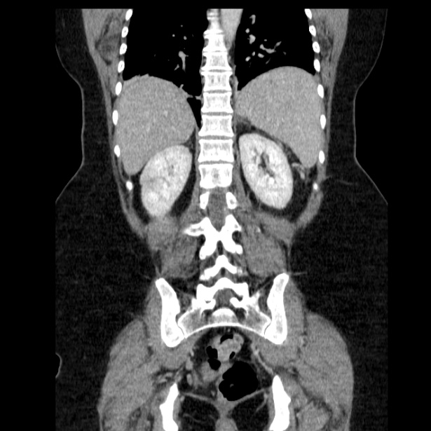 Acute pancreatitis - Balthazar C (Radiopaedia 26569-26714 Coronal C+ portal venous phase 50).jpg