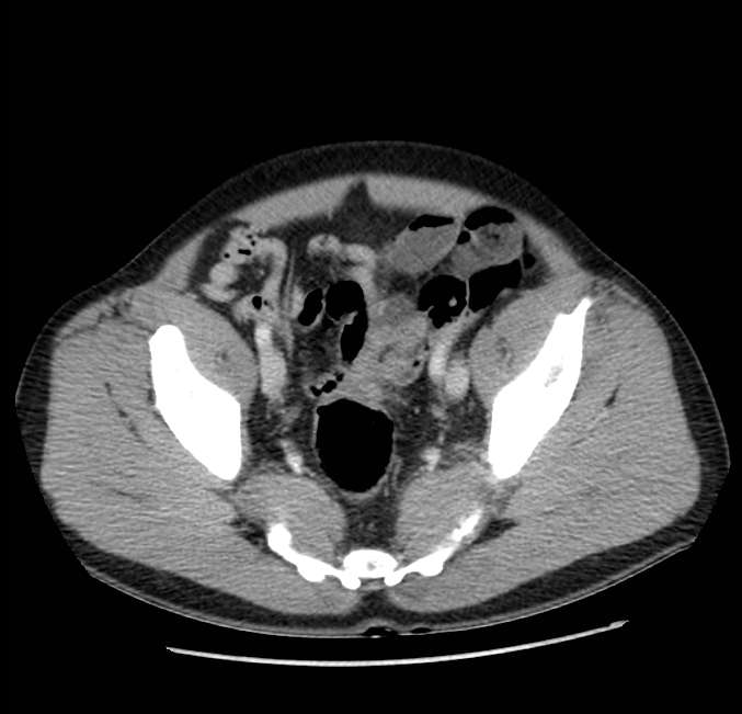 Acute pancreatitis - Balthazar E (Radiopaedia 23080-23110 Axial C+ portal venous phase 62).jpg