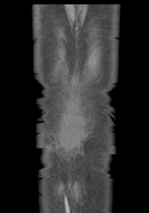 Acute pancreatitis and walled-off necrosis (Radiopaedia 29888-30403 E 54).jpg