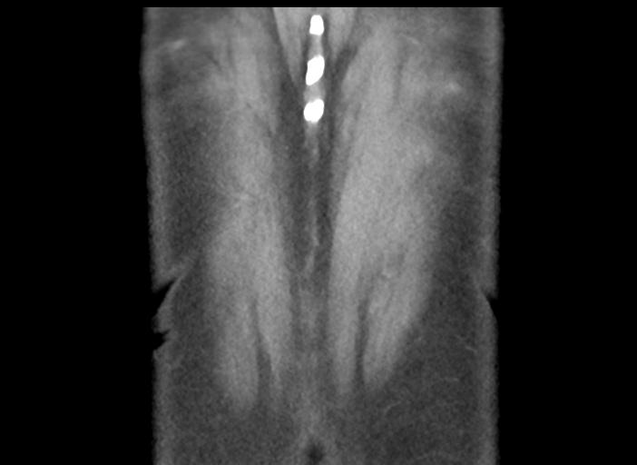 Acute pancreatitis and walled-off necrosis (Radiopaedia 29888-30404 Coronal C+ portal venous phase 50).jpg