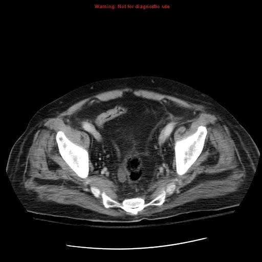 File:Acute pancreatitis with incidental pancreatic lipoma (Radiopaedia 10190-10730 Axial C+ portal venous phase 67).jpg