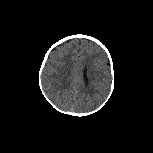 Acute phase of hemiconvulsion-hemiplegia epilepsy syndrome (Radiopaedia 29309-29744 Axial non-contrast 18).jpg