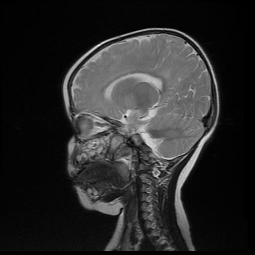 File:Acute phase of hemiconvulsion-hemiplegia epilepsy syndrome (Radiopaedia 29309-29745 Sagittal T2 9).jpg