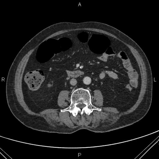 File:Acute renal artery occlusion (Radiopaedia 86586-102682 Axial C+ portal venous phase 47).jpg