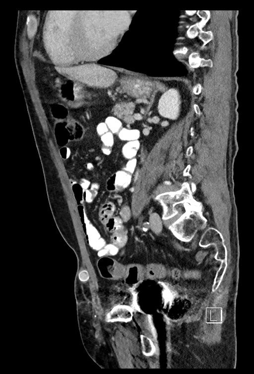 Acute renal infarction - rim capsular enhancement (Radiopaedia 59833-67270 Sagittal C+ portal venous phase 39).jpg