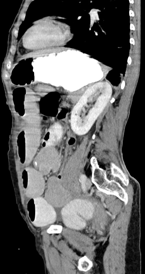 Acute small bowel (ileal) volvulus (Radiopaedia 71740-82139 Sagittal C+ portal venous phase 64).jpg