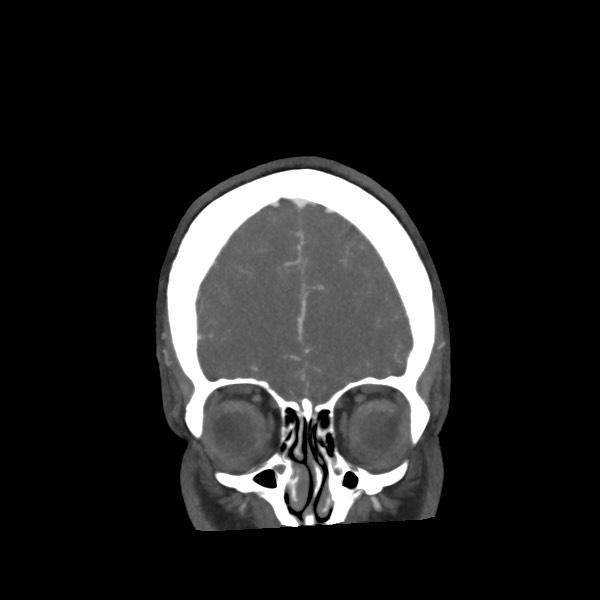 File:Acute subarachnoid hemorrhage and accessory anterior cerebral artery (Radiopaedia 69231-79009 Coronal C+ arterial phase 18).jpg