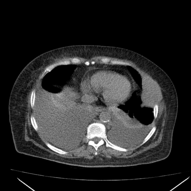 Acute tubular necrosis (Radiopaedia 28077-28334 Axial non-contrast 9).jpg