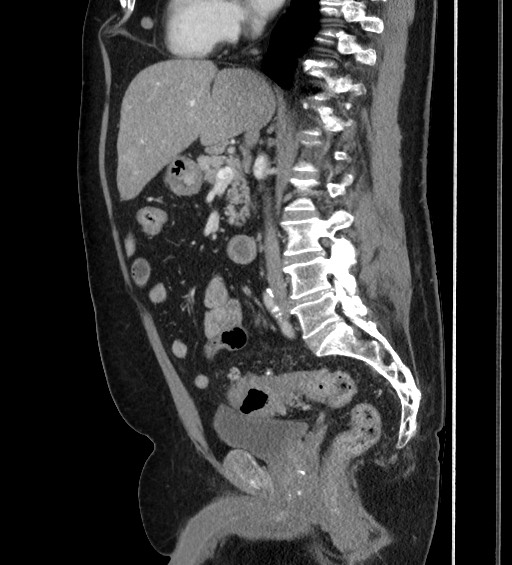 Acute unilateral nonhemorrhagic adrenal infarction (Radiopaedia 67560-76957 Axial renal excretory phase 9).jpg