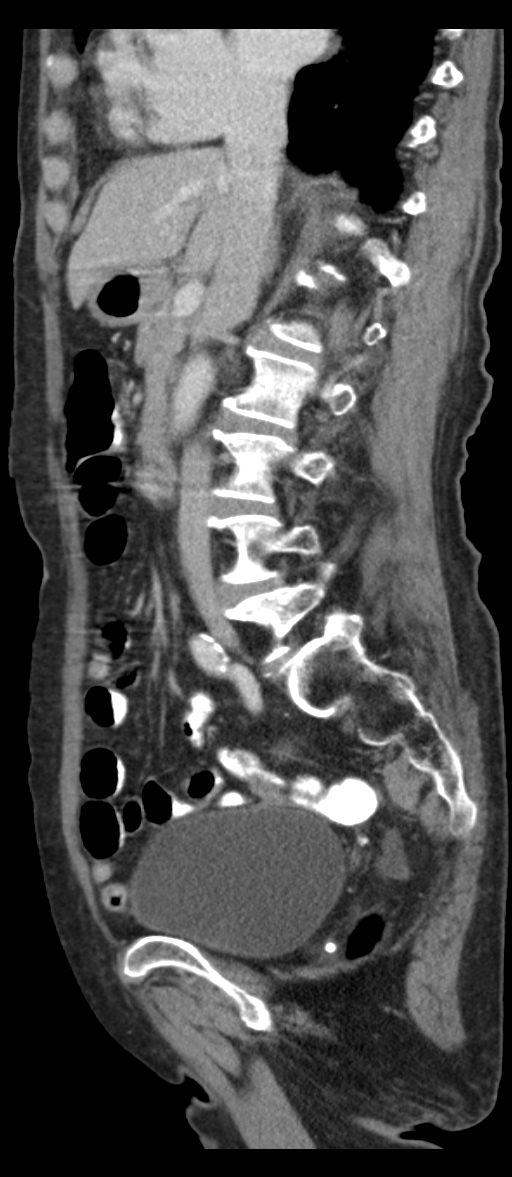 Adenocarcinoma of cecum (Radiopaedia 59222-66549 Sagittal C+ portal venous phase 55).jpg