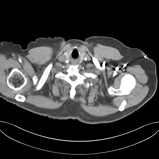 Adenocarcioma of rectum- T1 lesion (Radiopaedia 36921-38547 Axial C+ arterial phase 4).png