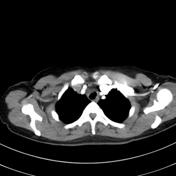 Adenocystic carcinoma of the trachea (Radiopaedia 47677-52525 Axial C+ arterial phase 33).jpg