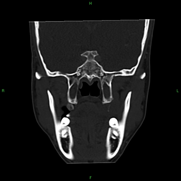 File:Adenoid cystic carcinoma of hard palate (Radiopaedia 26137-26273 Coronal bone window 16).jpg