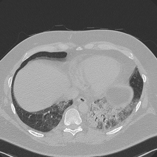 Adenoid cystic carcinoma of the trachea (Radiopaedia 49042-54137 Axial lung window 269).jpg