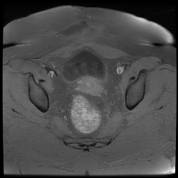 File:Adenomyosis within a didelphys uterus (Radiopaedia 70175-80215 Axial T1 fat sat 27).jpg