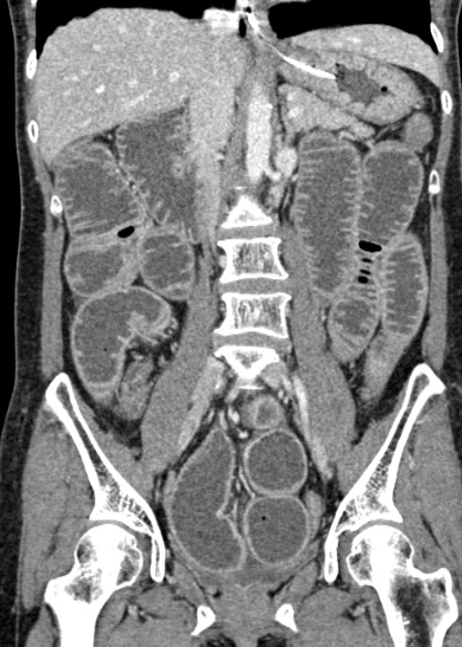 Adhesional small bowel obstruction (Radiopaedia 48397-53305 Coronal C+ portal venous phase 187).jpg
