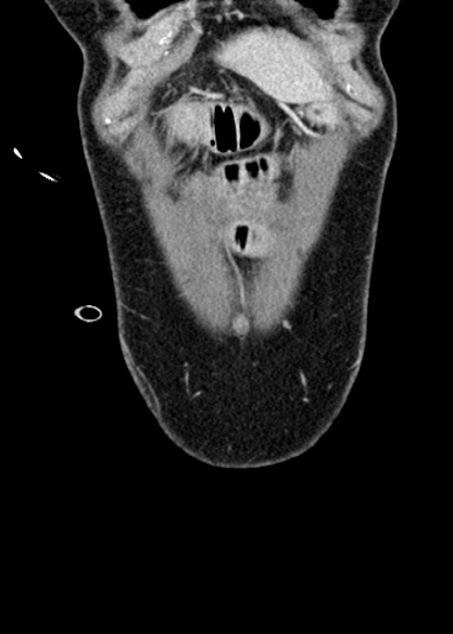 Adhesional small bowel obstruction (Radiopaedia 48397-53305 Coronal C+ portal venous phase 39).jpg