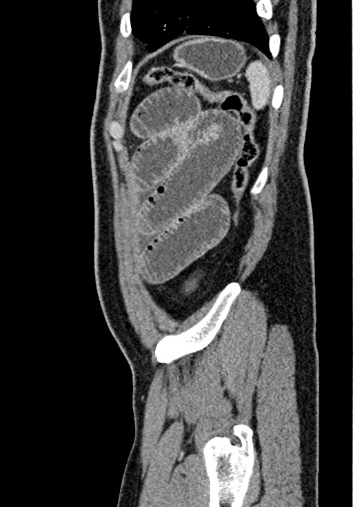 Adhesional small bowel obstruction (Radiopaedia 58900-66131 Sagittal C+ portal venous phase 217).jpg