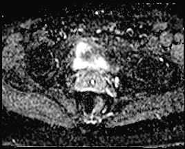 File:Adnexal multilocular cyst (O-RADS US 3. O-RADS MRI 3) (Radiopaedia 87426-103754 Axial 156).jpeg
