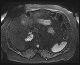 Adrenal cortical carcinoma (Radiopaedia 64017-72770 Axial DWI 54).jpg